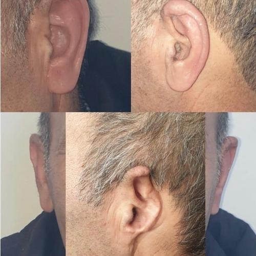Reconstrucción de la oreja Fotos del antes y el después
